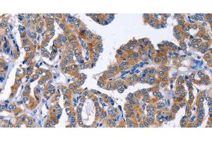 Immunohistochemistry of paraffin-embedded Human thyroid cancer tissue using IGSF10 Polyclonal Antibody at dilution 1:50 (IGSF10 抗体)