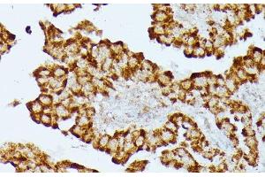 Immunohistochemistry of paraffin-embedded Human thyroid cancer using HMGCS2 Polyclonal Antibody at dilution of 1:100 (40x lens). (HMGCS2 抗体)