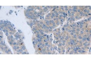 Immunohistochemistry of paraffin-embedded Human liver cancer tissue using GRIN1 Polyclonal Antibody at dilution 1:50 (GRIN1/NMDAR1 抗体)