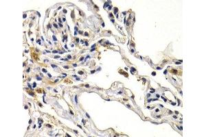 Immunohistochemistry of paraffin-embedded Human lung cancer using WNT3A Polyclonal Antibody at dilution of 1:200 (40x lens). (WNT3A 抗体)