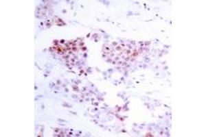 Immunohistochemistry analysis of paraffin-embedded human breast carcinoma tissue, using MEF2A (Ab-319) Antibody. (MEF2A 抗体  (AA 296-345))