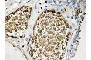 Immunohistochemistry analyzes of FosB antibody in paraffin-embedded human prostate carcinoma tissue.