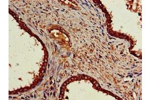 Immunohistochemistry of paraffin-embedded human prostate cancer using ABIN7161911 at dilution of 1:100 (NR5A2 + LRH1 抗体  (AA 182-291))