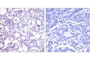Immunohistochemistry analysis of paraffin-embedded human breast carcinoma tissue, using NF-kappaB p105/p50 (Ab-893) Antibody. (NFKB1 抗体  (AA 860-909))