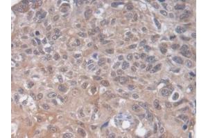 DAB staining on IHC-P; Samples: Human Lung cancer Tissue (HS2ST1 抗体  (AA 29-356))