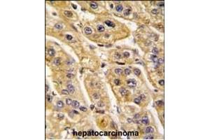 Formalin-fixed and paraffin-embedded human hepatocarcinoma tissue reacted with HIBCH antibody (Center), which was peroxidase-conjugated to the secondary antibody, followed by DAB staining. (HIBCH 抗体  (AA 183-209))