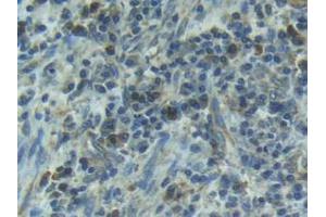 IHC-P analysis of Human Esophagus Cancer Tissue, with DAB staining. (IL1R1 抗体  (AA 21-109))