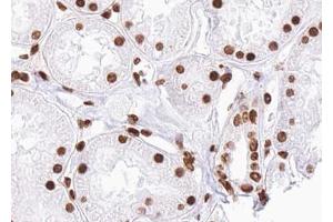 ABIN6267658 at 1/100 staining human kidney carcinoma tissue sections by IHC-P. (SMAD2 抗体  (pSer467))