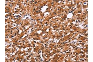 The image on the left is immunohistochemistry of paraffin-embedded Human thyroid cancer tissue using ABIN7192526(SLC8A2 Antibody) at dilution 1/15, on the right is treated with synthetic peptide. (SLC8A2 抗体)