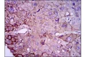 Immunohistochemical analysis of paraffin-embedded liver cancer tissues using RAB4A mouse mAb with DAB staining.