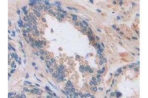 Detection of ARRb1 in Human Prostate Tissue using Polyclonal Antibody to Arrestin Beta 1 (ARRb1)