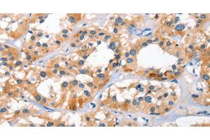 Immunohistochemistry of paraffin-embedded Human thyroid cancer tissue using BNIP3L Polyclonal Antibody at dilution 1:40 (BNIP3L/NIX 抗体)