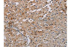 The image on the left is immunohistochemistry of paraffin-embedded Human prostate cancer tissue using ABIN7191864(PHKA2 Antibody) at dilution 1/30, on the right is treated with synthetic peptide. (PHKA2 抗体)