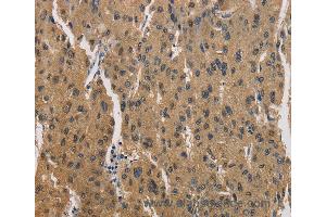 Immunohistochemistry of Human liver cancer using CKMT2 Polyclonal Antibody at dilution of 1:60 (CKMT2 抗体)