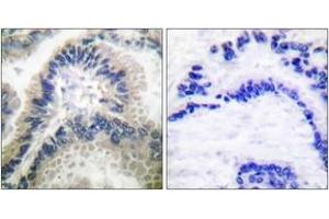 Immunohistochemistry analysis of paraffin-embedded human lung carcinoma tissue, using Guanylate Cyclase beta Antibody. (GUCYB 抗体  (AA 10-59))
