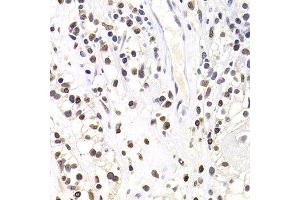 Immunohistochemistry of paraffin-embedded human kidney cancer using SOX5 antibody at dilution of 1:100 (x400 lens). (SOX5 抗体)