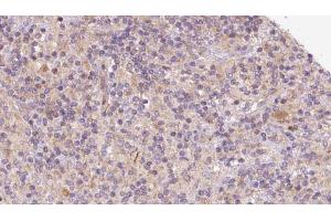 ABIN6273099 at 1/100 staining Human lymph cancer tissue by IHC-P.