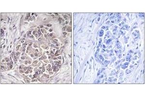 Immunohistochemistry analysis of paraffin-embedded human breast carcinoma tissue, using PEX1 Antibody. (PEX1 抗体  (AA 1234-1283))