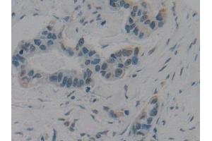 Detection of HMGB1 in Human Breast cancer Tissue using Polyclonal Antibody to High Mobility Group Protein 1 (HMGB1) (HMGB1 抗体  (AA 9-163))