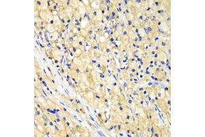 Immunohistochemistry of paraffin-embedded human lung cancer using NUP62 antibody. (NUP62 抗体  (AA 403-522))