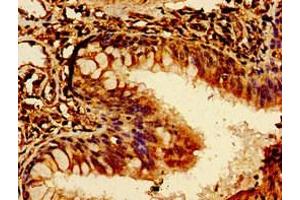 Immunohistochemistry of paraffin-embedded human lung cancer using ABIN7174072 at dilution of 1:100 (ROR2 抗体  (AA 752-926))