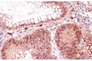 Immunohistochemistry of paraffin-embedded Human colon carcinoma using S100P Polyclonal Antibody at dilution of 1:100 (40x lens). (S100P 抗体)