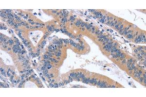 Immunohistochemistry of paraffin-embedded Human colon cancer tissue using GDF11 Polyclonal Antibody at dilution 1:30 (GDF11 抗体)