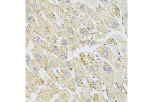 Immunohistochemistry of paraffin-embedded human liver injury using HSD17B13 Antibody. (HSD17B13 抗体  (AA 20-300))