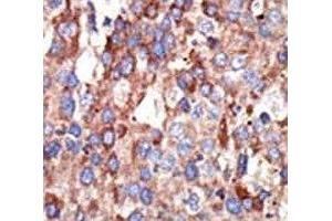 IHC analysis of FFPE human hepatocarcinoma tissue stained with the YY1 antibody (YY1 抗体  (AA 268-297))