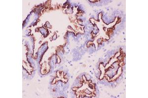 Anti-MUC1 Picoband antibody,  IHC(P): Human Ovary Cancer Tissue (MUC1 抗体  (AA 935-1097))