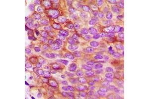 Immunohistochemical analysis of IL-5 staining in human breast cancer formalin fixed paraffin embedded tissue section.