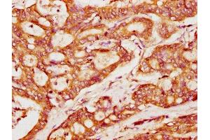 IHC image of ABIN7165686 diluted at 1:400 and staining in paraffin-embedded human colon cancer performed on a Leica BondTM system.