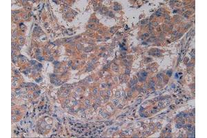 IHC-P analysis of Human Breast Cancer Tissue, with DAB staining. (CD40 抗体  (AA 26-187))