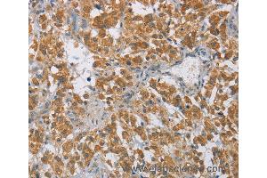 Immunohistochemistry of Human cervical cancer using DIDO1 Polyclonal Antibody at dilution of 1:60 (DIO1 抗体)