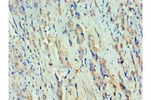 Immunohistochemistry of paraffin-embedded human colon cancer using ABIN7150384 at dilution of 1:100 (RFX5 抗体  (AA 367-616))