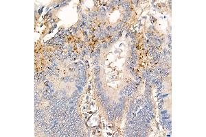 Immunohistochemistry of paraffin-embedded human colon carcinoma using MMP7 Rabbit mAb (ABIN7268425) at dilution of 1:150 (40x lens). (MMP7 抗体)