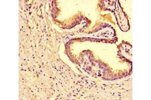Immunohistochemistry of paraffin-embedded human prostate cancer using ABIN7171500 at dilution of 1:100 (TNKS2 抗体  (AA 1-246))