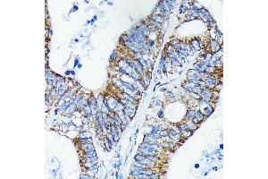 Immunohistochemistry of paraffin-embedded human colon carcinoma using TNF Rabbit mAb (ABIN7271076) at dilution of 1:100 (40x lens). (TNFAIP3 抗体)
