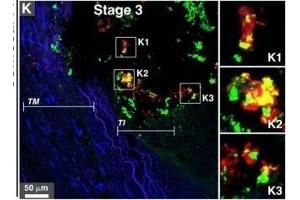 Immunohistological staining of artery tissues from diabetic subjects showing colocalization of serum proteins and mineral deposits.