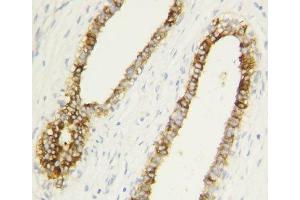 Caspase-1 antibody testing of human breast cancer tissue by IHC-P. (Caspase 1 抗体  (AA 249-262))