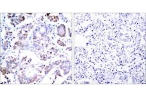 Immunohistochemistry analysis of paraffin-embedded human breast carcinoma tissue, using NF-kappaB p65 (Ab-254) Antibody. (NF-kB p65 抗体  (AA 221-270))