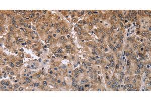 Immunohistochemistry of paraffin-embedded Human liver cancer using MAPRE3 Polyclonal Antibody at dilution of 1:50 (MAPRE3 抗体)