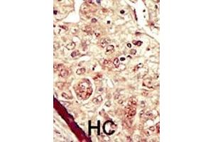Formalin-fixed and paraffin-embedded human cancer tissue reacted with the primary antibody, which was peroxidase-conjugated to the secondary antibody, followed by DAB staining. (STK16 抗体  (C-Term))