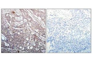 Immunohistochemical analysis of paraffin-embedded human breast carcinoma tissue using IkB-b(Phospho-Ser23) Antibody(left) or the same antibody preincubated with blocking peptide(right). (NFKBIB 抗体  (pSer23))
