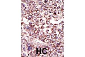 Formalin-fixed and paraffin-embedded human hepatocellular carcinoma tissue reacted with RPN2 polyclonal antibody  , which was peroxidase-conjugated to the secondary antibody, followed by DAB staining . (Ribophorin II 抗体  (N-Term))