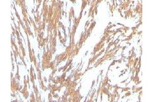 Formalin-fixed, paraffin-embedded human Leiomyosarcoma stained with alpha Smooth Muscle Actin antibody (ACTA2/791). (Smooth Muscle Actin 抗体)