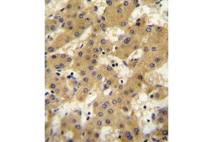 OF antibody (Center) 10107c immunohistochemistry analysis in formalin fixed and paraffin embedded human hepatocarcinoma followed by peroxidase conjugation of the secondary antibody and DAB staining. (Apolipoprotein F 抗体  (AA 111-138))