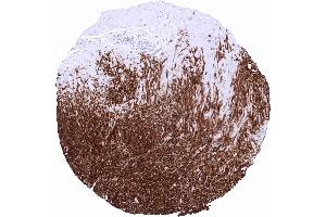 Dog1 Tumor periphery of a GIST showing intensive DOG1 staining in all tumor cells (ANO1 抗体  (AA 2-101))