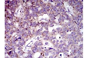 Immunohistochemical analysis of paraffin-embedded esophageal cancer tissues using MRPL42 mouse mAb with DAB staining. (MRPL42 抗体  (AA 10-142))