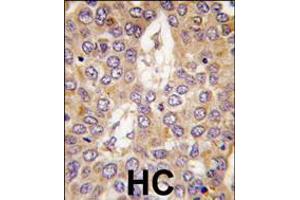 Formalin-fixed and paraffin-embedded human hepatocarcinoma tissue reacted with CK1g2 antibody , which was peroxidase-conjugated to the secondary antibody, followed by DAB staining. (Casein Kinase 1 gamma 2 抗体  (C-Term))